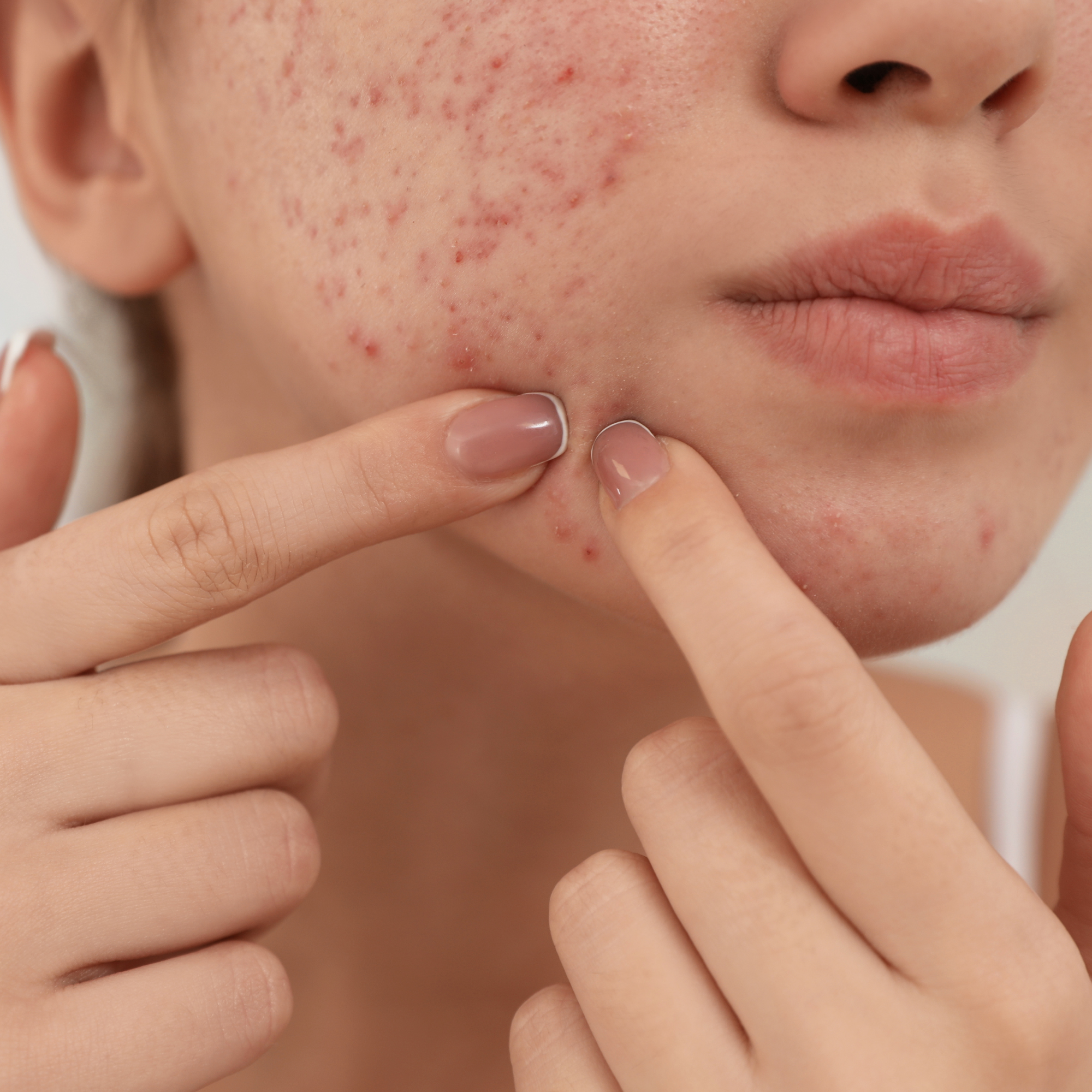 What are the best facial treatments for acne?