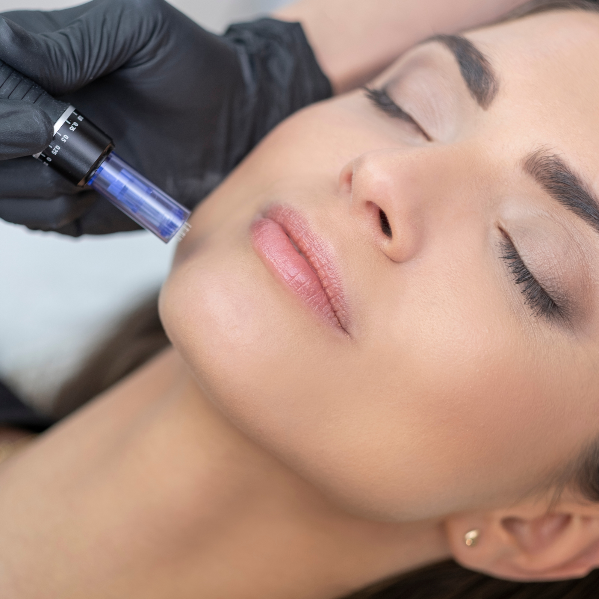 Who is Suitable for Skin Needling?